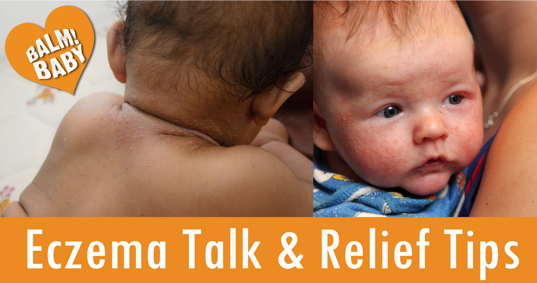 ECZEMA: LIVING AND CARING FOR IT + HOW TO PROMOTE AND SUSTAIN HEALTHY SKIN